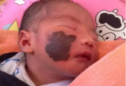 寶寶出生胎記和媽媽有關嗎 如何預防寶寶長胎記