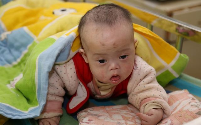 孩子得了腦癱能治好嗎 孩子腦癱的最佳治療時間