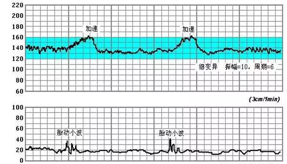 胎心率看胎兒性別有用嗎 怎么從胎心率看胎兒的性別 胎心率看胎兒性別有用嗎 怎么從胎心率看胎兒的性別