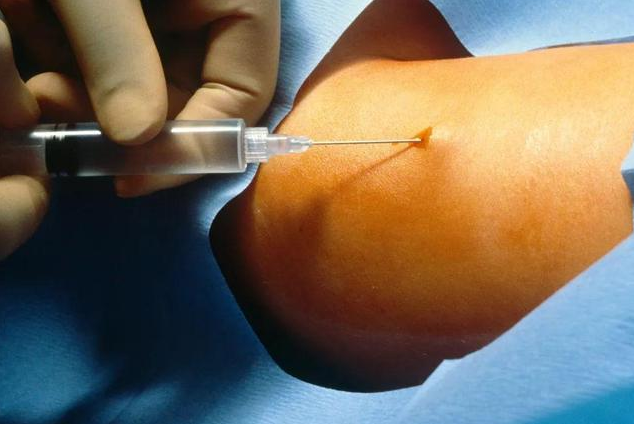 皮埋避孕法有效期是多久 皮埋避孕優缺點分析