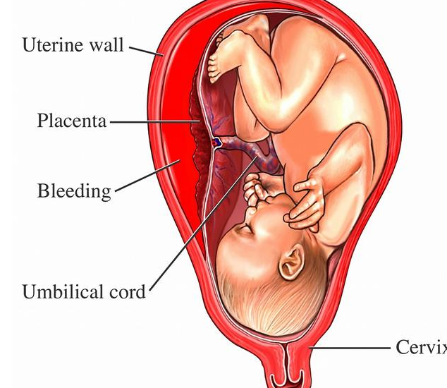 胎盤早剝的常見病因是什么 胎盤早剝可以保胎嗎 胎盤早剝的常見病因是什么 胎盤早剝可以保胎嗎