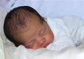 寶寶濕疹的類型有哪些 寶寶濕疹如何護理