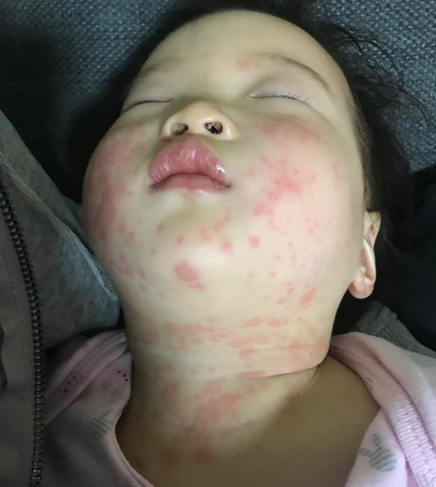 怎么區(qū)分川崎病和感冒 小兒川崎病怎么預(yù)防