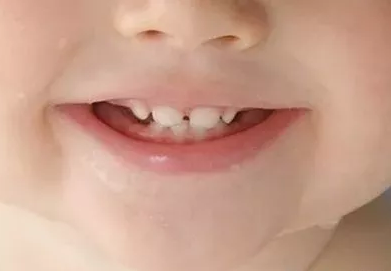 寶寶牙齒變黑是缺鈣嗎 寶寶牙齒長黑斑怎么預防 寶寶牙齒變黑是缺鈣嗎 寶寶牙齒長黑斑怎么預防