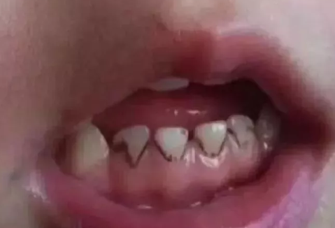 寶寶牙齒變黑是缺鈣嗎 寶寶牙齒長黑斑怎么預防 寶寶牙齒變黑是缺鈣嗎 寶寶牙齒長黑斑怎么預防