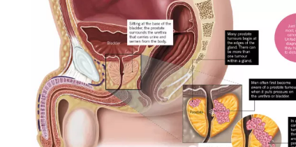 男性前列腺炎怎么預防 得了前列腺炎該怎么辦 男性前列腺炎怎么預防 得了前列腺炎該怎么辦