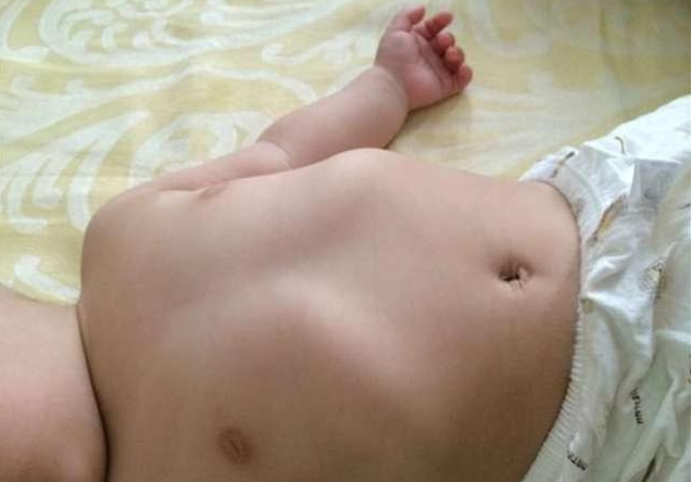 寶寶肋骨外翻就是缺鈣嗎 怎么預防寶寶肋骨外翻 寶寶肋骨外翻就是缺鈣嗎 怎么預防寶寶肋骨外翻