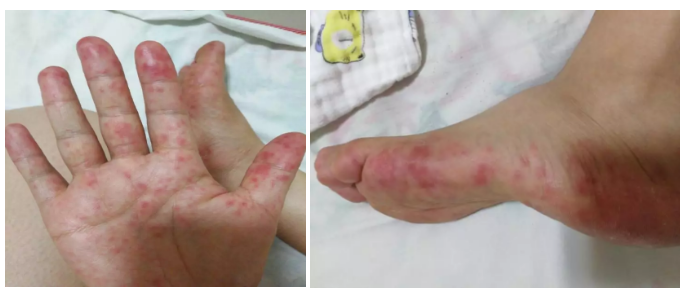 皰疹性咽峽炎和手足口病有什么不同 手足口病和皰疹性咽峽炎這兩個(gè)病很嚴(yán)重嗎