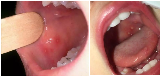 皰疹性咽峽炎和手足口病有什么不同 手足口病和皰疹性咽峽炎這兩個(gè)病很嚴(yán)重嗎