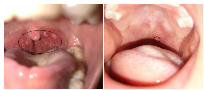 皰疹性咽峽炎和手足口病有什么不同 手足口病和皰疹性咽峽炎這兩個(gè)病很嚴(yán)重嗎