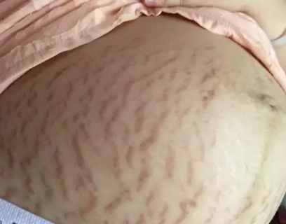 懷孕之后才會有妊娠紋嗎 妊娠紋是什么時候會出現 懷孕之后才會有妊娠紋嗎 妊娠紋是什么時候會出現