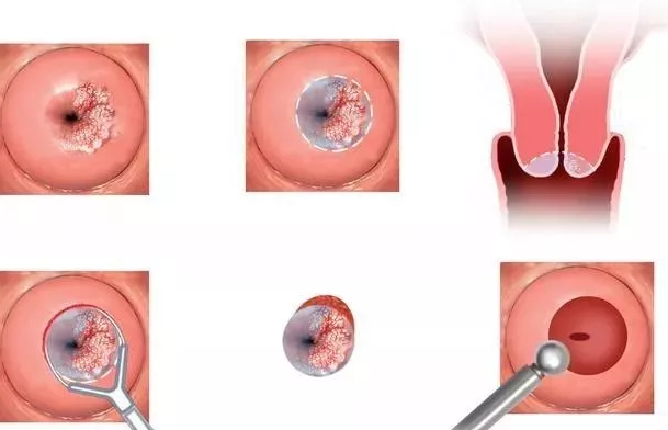 宮頸糜爛術(shù)后會影響生育嗎 宮頸糜爛怎么治療 宮頸糜爛術(shù)后會影響生育嗎 宮頸糜爛怎么治療