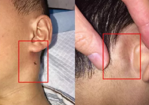 小孩淋巴結腫大怎么辦 小孩淋巴結腫大危險嗎