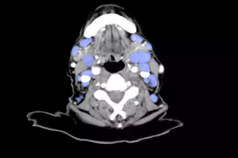 寶寶淋巴結變大怎么辦 寶寶淋巴結變大發(fā)炎怎么治療 寶寶淋巴結變大怎么辦 寶寶淋巴結變大發(fā)炎怎么治療