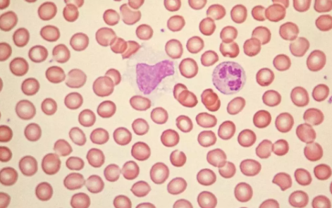 小孩淋巴結腫大的食療方法 小孩淋巴結腫大不能吃什么