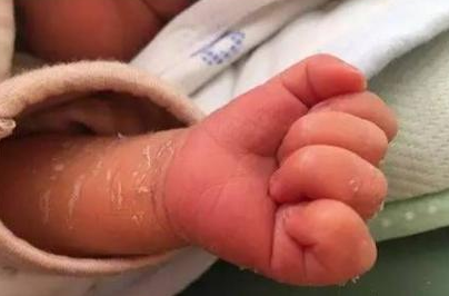 新生兒身上褪皮是怎么回事 新生兒起皮怎么辦