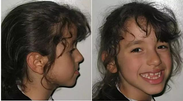 孩子牙齒地包天是怎么形成的 牙齒地包天怎么預(yù)防和治療