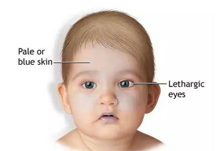 嬰兒搖晃綜合癥是什么 哄寶寶別搖晃寶寶