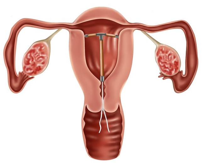 產(chǎn)后上環(huán)出現(xiàn)哪些癥狀要注意 產(chǎn)后什么時(shí)間上環(huán)比較好 產(chǎn)后上環(huán)出現(xiàn)哪些癥狀要注意 產(chǎn)后什么時(shí)間上環(huán)比較好