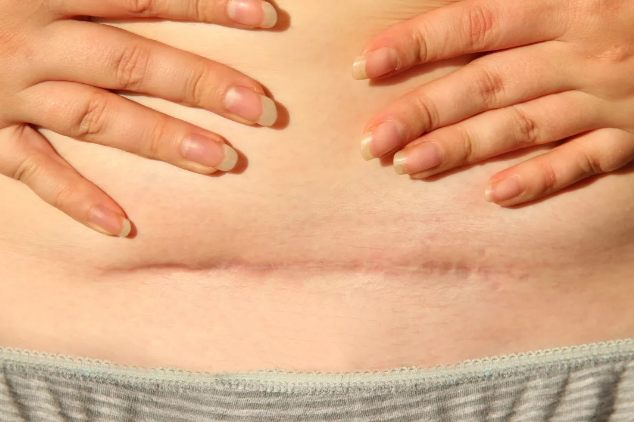 剖腹產(chǎn)后的疤痕是不是一定會(huì)增生 剖腹產(chǎn)后的疤痕如何改善 剖腹產(chǎn)后的疤痕是不是一定會(huì)增生 剖腹產(chǎn)后的疤痕如何改善