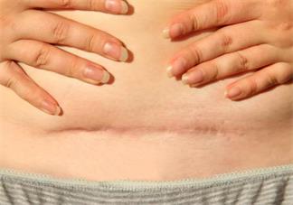 剖腹產后的疤痕是不是一定會增生 剖腹產后的疤痕如何改善