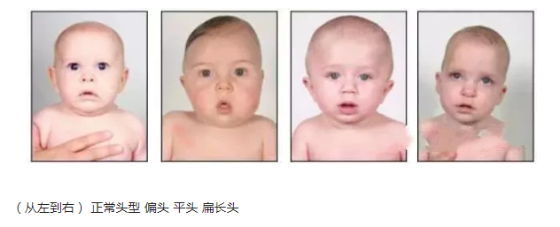 嬰兒正常頭型什么樣的 嬰兒正常頭型圖片正面側面