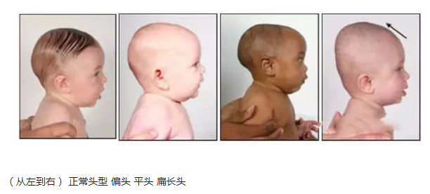 嬰兒正常頭型什么樣的 嬰兒正常頭型圖片正面側面