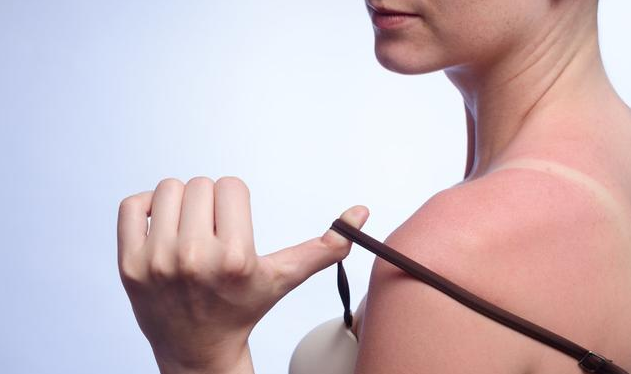 夏季曬傷處理小妙招 夏季如何正確防曬 夏季曬傷處理小妙招 夏季如何正確防曬