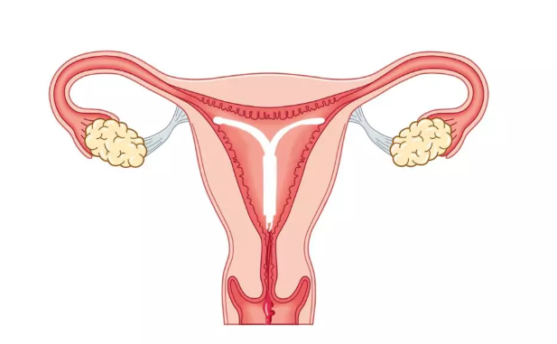 上曼月樂環后月經能恢復嗎 上曼月樂環月經多久正常 上曼月樂環后月經能恢復嗎 上曼月樂環月經多久正常
