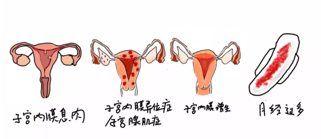 上曼月樂環(huán)不來月經(jīng)正常嗎 上曼月樂環(huán)月經(jīng)量減少有影響嗎