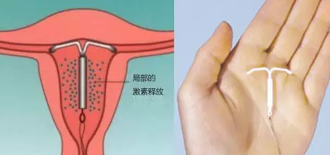 上曼月樂環后流血怎么回事 上曼月樂環流血是副作用嗎