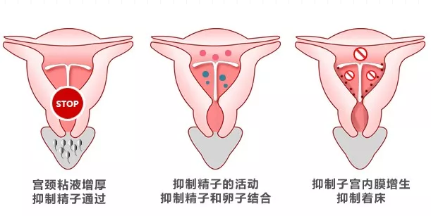 上曼月樂環會長了囊腫嗎 子宮長囊腫和曼月樂環有關嗎 上曼月樂環會長了囊腫嗎 子宮長囊腫和曼月樂環有關嗎