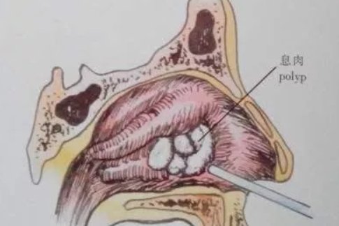 上曼月樂環后子宮會越來越大嗎 上曼月樂環對子宮影響