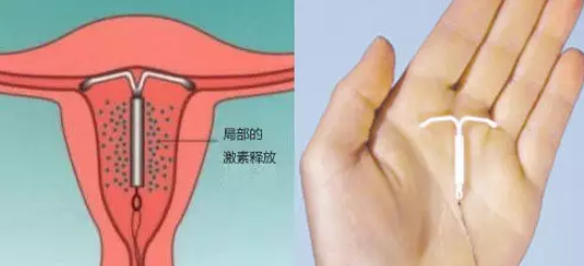 上曼月樂環會臉上長痘嗎 曼月樂環孕激素會引起長痘嗎