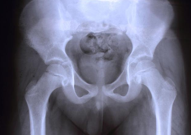 B超可以查出盆腔積液嗎 盆腔積液是怎么來的 B超可以查出盆腔積液嗎 盆腔積液是怎么來的