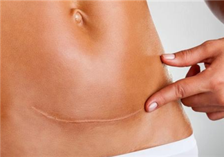 剖腹產疤痕增生受哪些因素影響 如何預防剖腹產疤痕增生