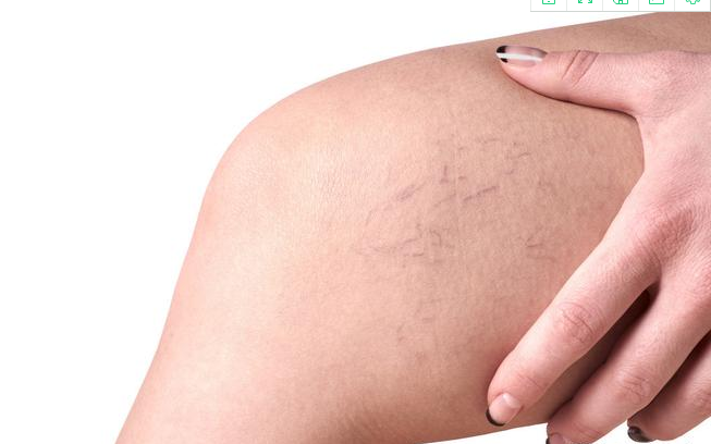 懷孕之后靜脈曲張是怎么回事 如何預防孕期靜脈曲張