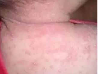 寶寶長痱子為什么不能用痱子粉 寶寶長痱子了該怎么辦