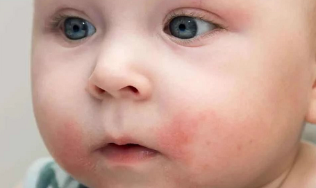 寶寶長痱子為什么不能用痱子粉 寶寶長痱子了該怎么辦