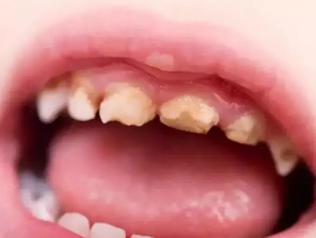 寶寶使用奶瓶有什么危害 寶寶奶瓶用到什么時候 寶寶使用奶瓶有什么危害 寶寶奶瓶用到什么時候