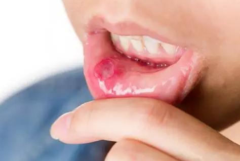 寶寶口腔潰瘍反復發作是怎么回事 寶寶口腔潰瘍是缺鋅了嗎