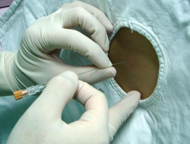 剖腹產打麻藥打哪里 剖腹產打麻藥有什么感覺