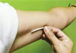 皮下埋值避孕手術什么時候做合適 皮埋避孕法的副作用