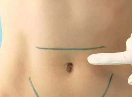 剖腹產橫切口和豎切口有什么區別 橫切口和豎切口哪個比較好