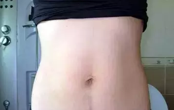 剖腹產橫切口和豎切口有什么區別 橫切口和豎切口哪個比較好