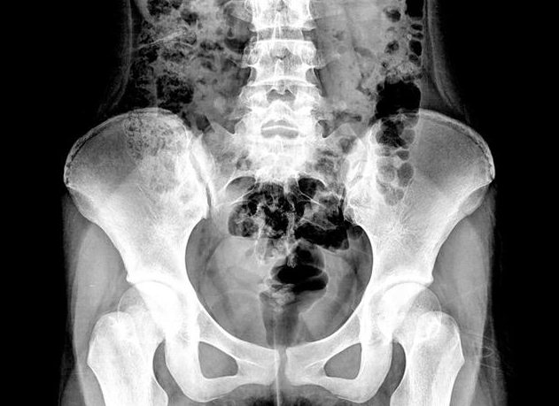 盆腔積液和盆腔炎有什么關(guān)系 B超顯示盆腔積液怎么回事