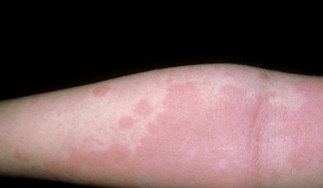 孕婦蕁麻疹會(huì)遺傳給寶寶嗎 孕婦得了蕁麻疹怎么護(hù)理