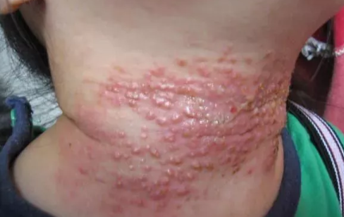 ?寶寶淹脖子破皮怎么辦 寶寶淹脖子癥狀有哪些