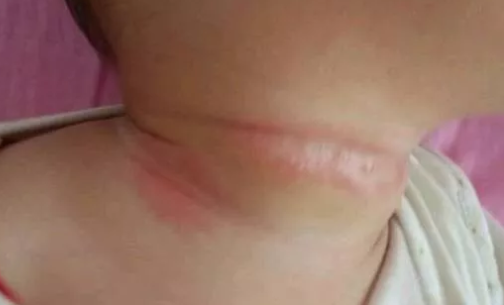 寶寶淹脖子可以用爽身粉嗎 寶寶淹脖子用爽身粉護(hù)理好不好