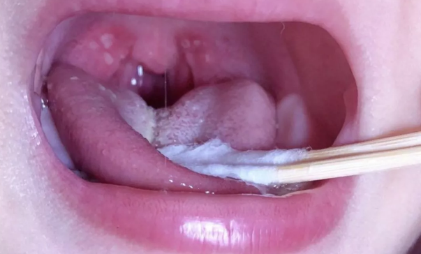 孩子皰疹性咽頰炎有什么癥狀 孩子為什么會得皰疹性咽頰炎